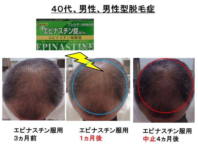 円形脱毛症　病院